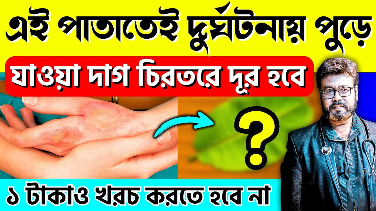 🌿১ টি পাতাতেই পুড়ে যাওয়া ত্বক চিরতরে সারিয়ে তুলুন ঘরোয়া ৫ উপায়ে | পোড়া দাগ Burn scars দূর করার উপায়