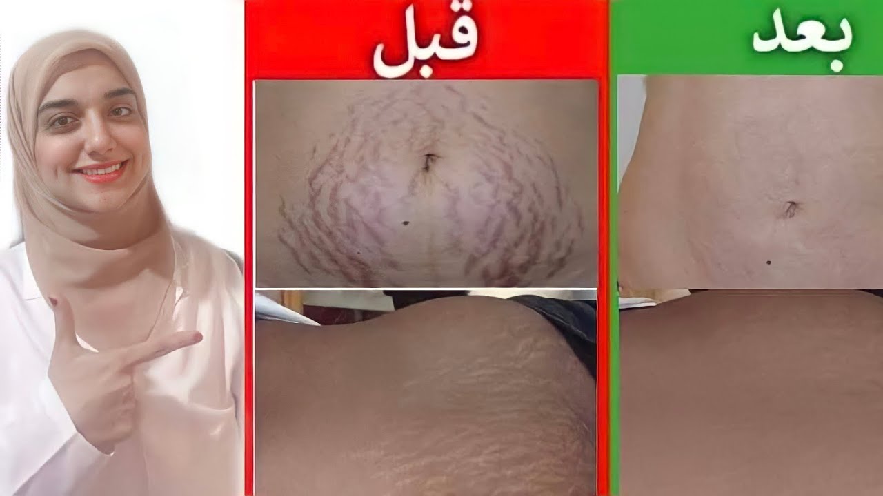 وصفة لعلاج الخطوط الحمراء والبيضاء في الجسم نهائيا