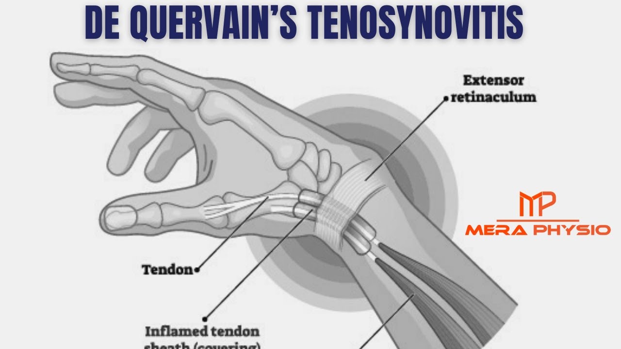 De Quervain’s Tenosynovitis | In Hindi | Mera Physio