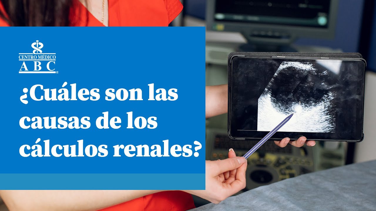 &iquest;Cu&aacute;les son las causas de los c&aacute;lculos renales?