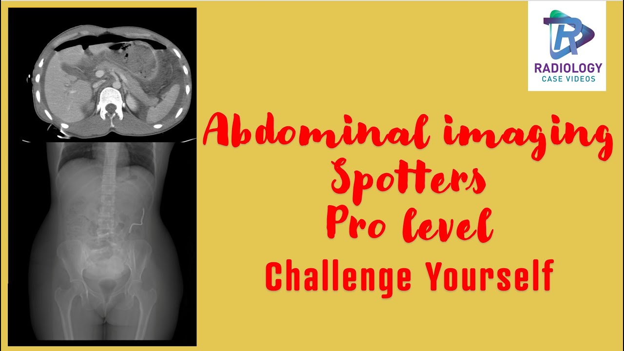Abdomen imaging spotters PRO level challenge yourself#FRCR Spots#Edir Spots# Turtle back liver#
