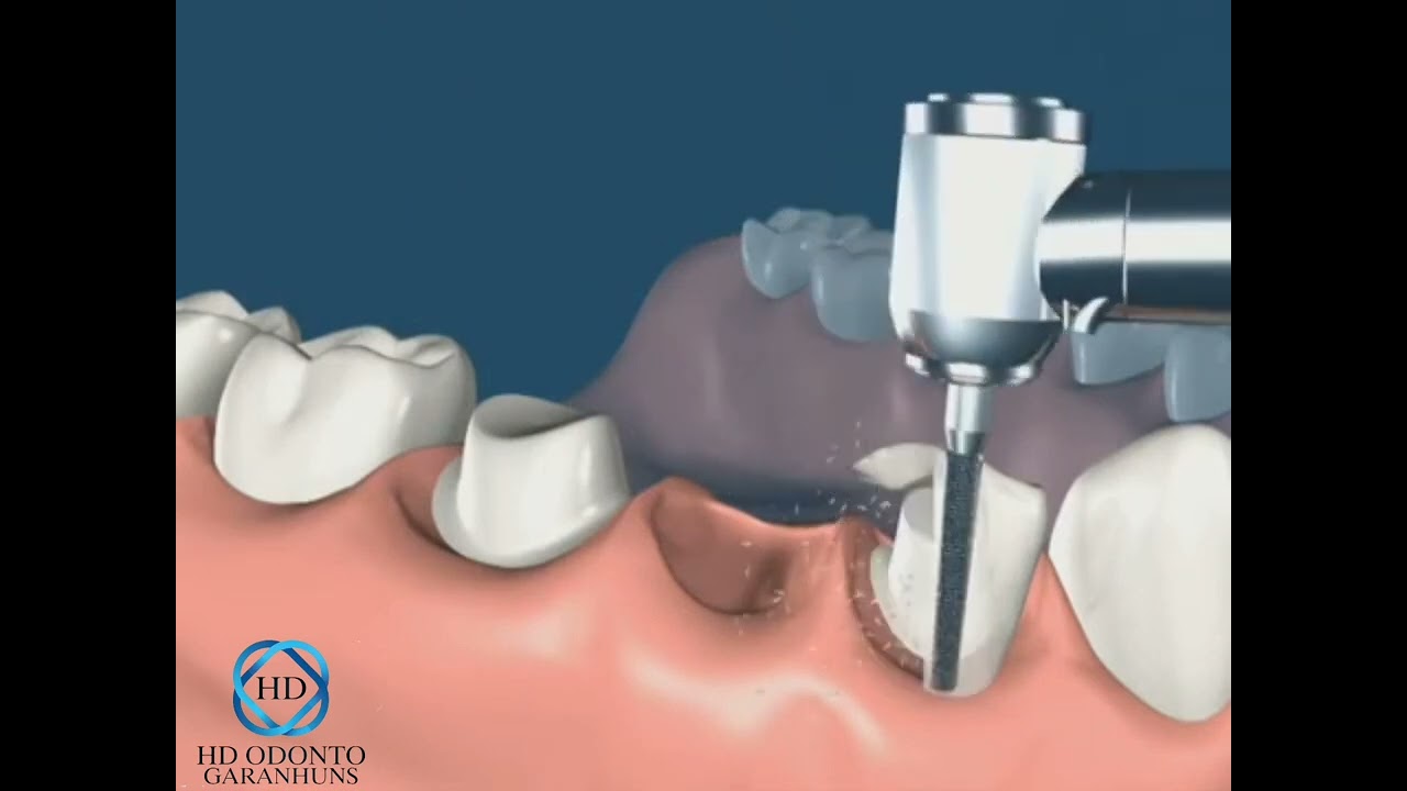 Dentes fixos sem implantes