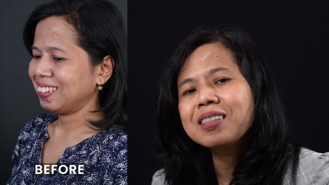How it feels after Smile Designing Treatment | Smile Designing Hyderabad | Dr Jaydev Dental Clinic