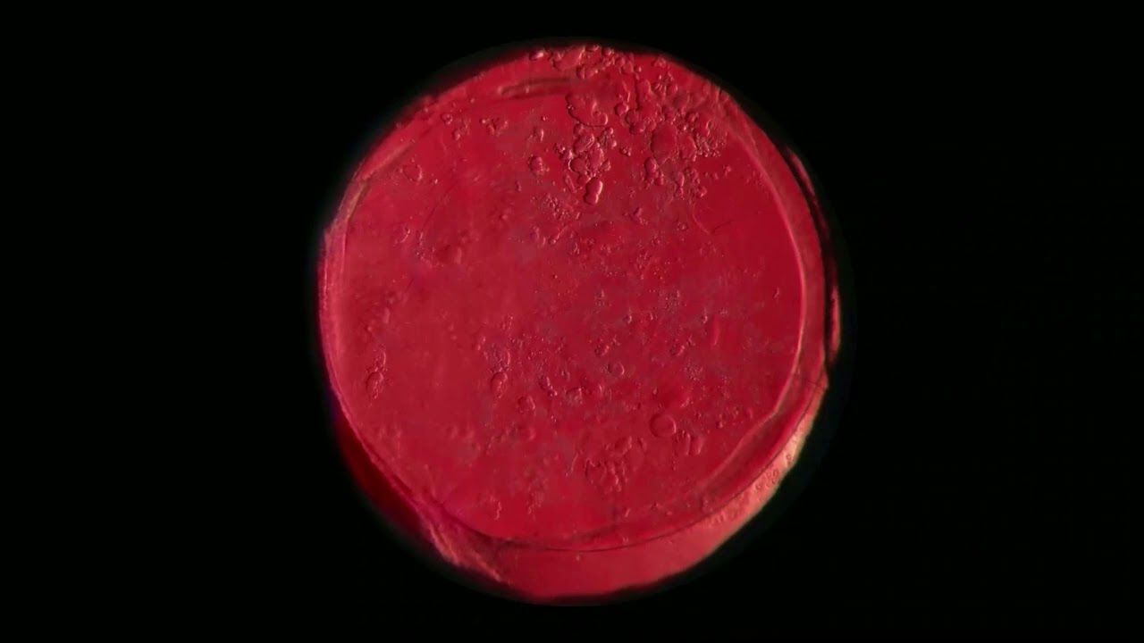 YAG Posterior Capsulotomy: The final hurdle to a Premium Visual Outcome
