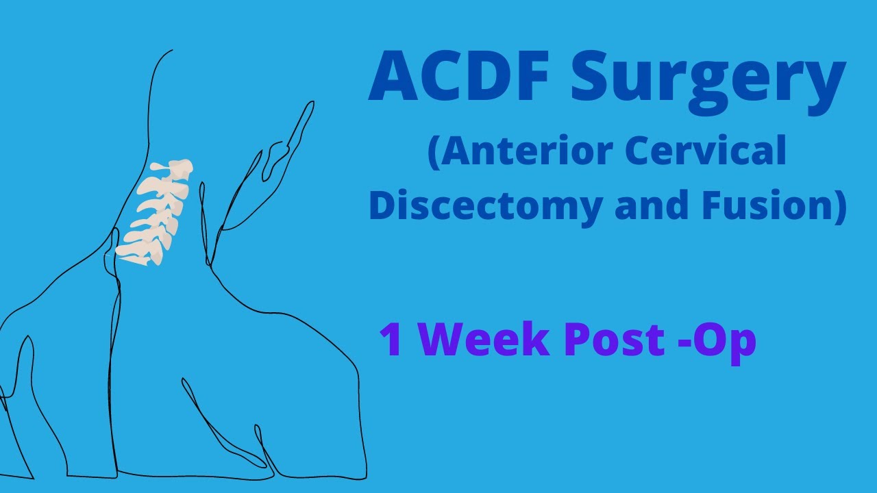 ACDF Surgery Diary-1 week post op-Honest discussion of outcome so far