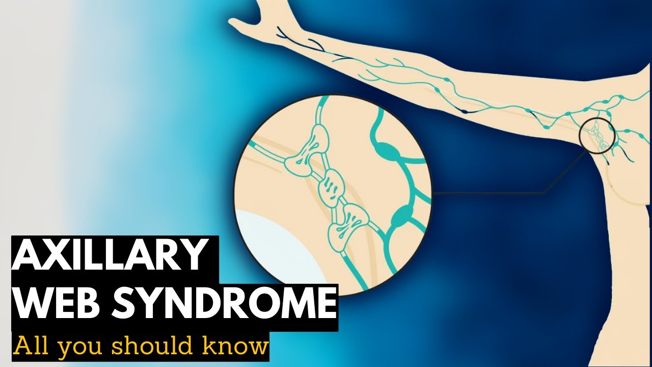 Axillary Web Syndrome: Everything You Need To Know