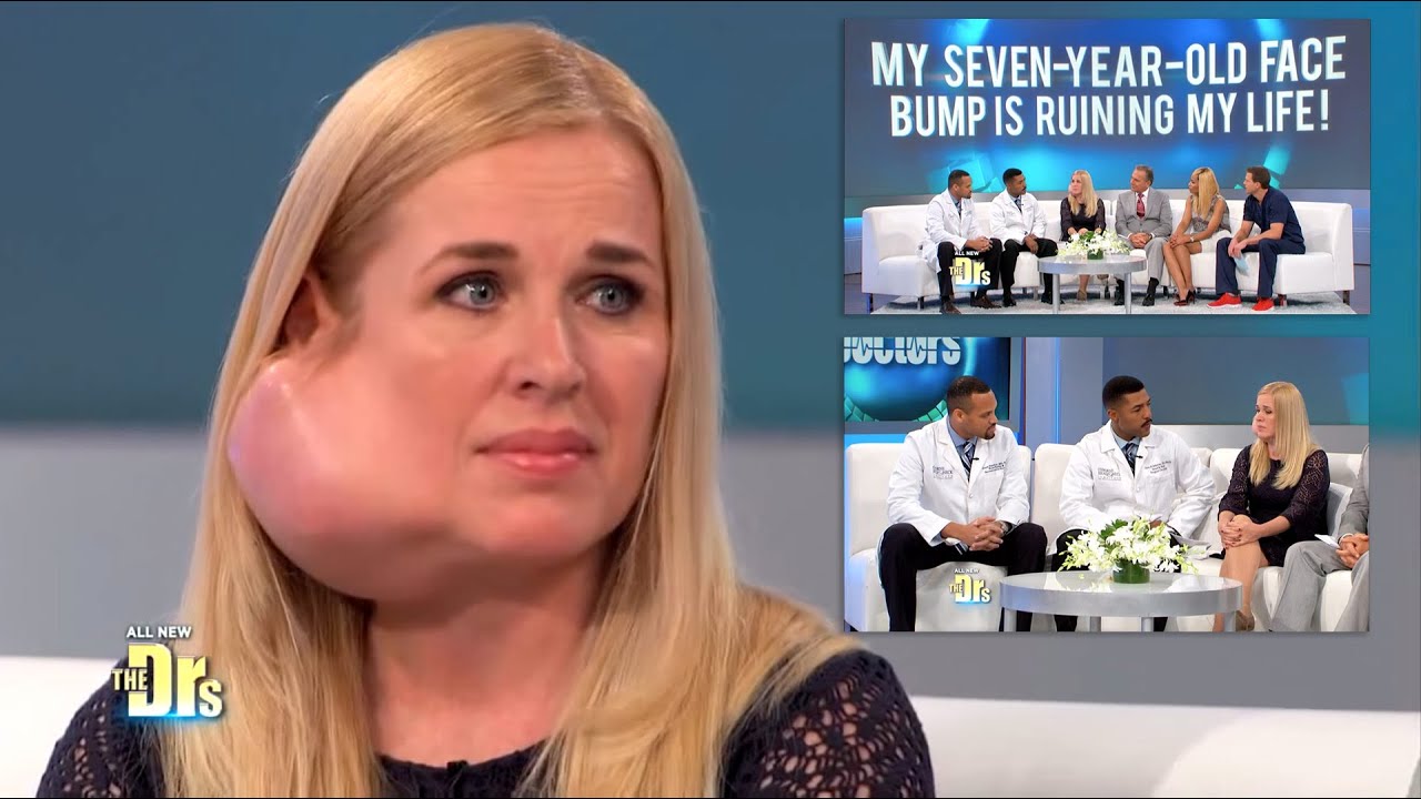 Parotid Tumor Surgery on The Doctors TV Show Changed My Life (Surgeon: Dr. Ryan Osborne)