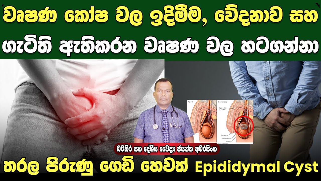 වෘෂණ කෝෂ ඉදිමීම, වේදනාව සහ ගැටිති ඇතිකරන වෘෂණ වල තරල පිරුණු ගෙඩි ඇතිවීම Epididymal Cyst