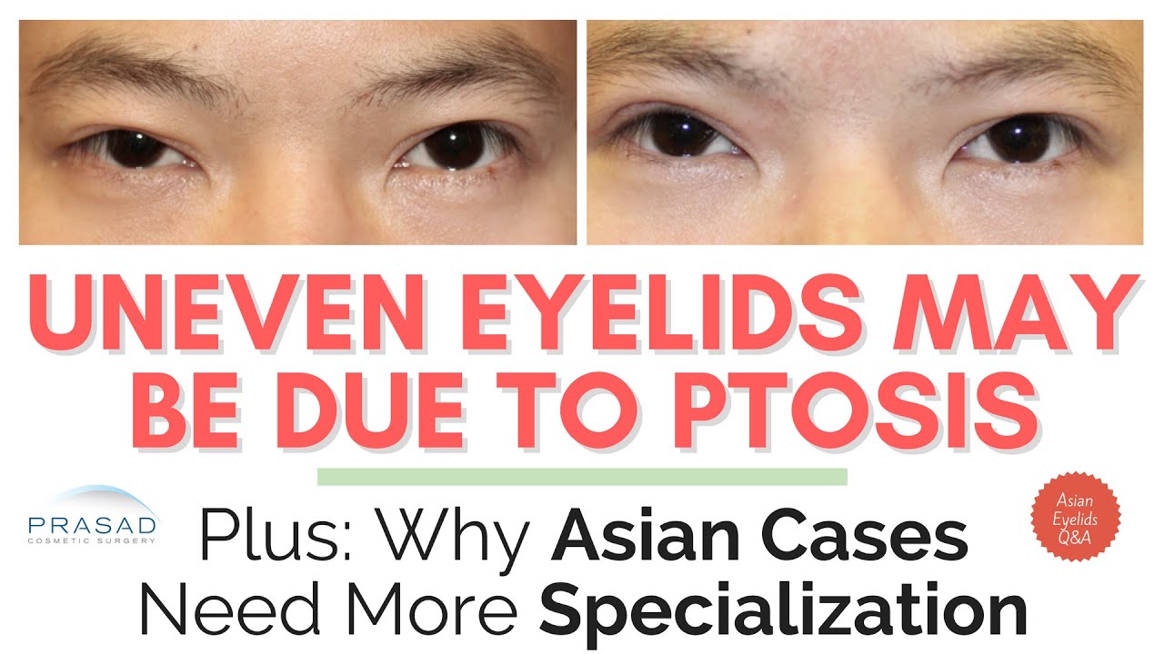 Why Uneven Eyelids may be due to Ptosis, and Differences in Correction for Asian Eyelids