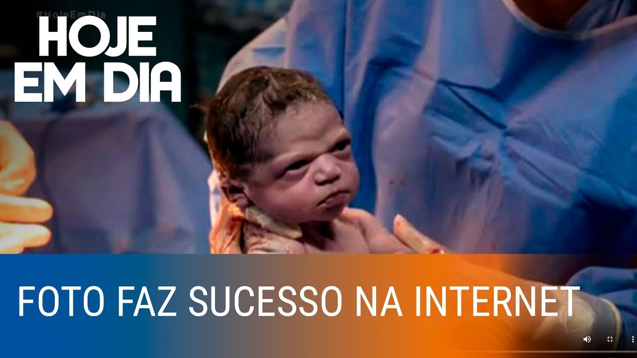 Bebê nasce com cara de 