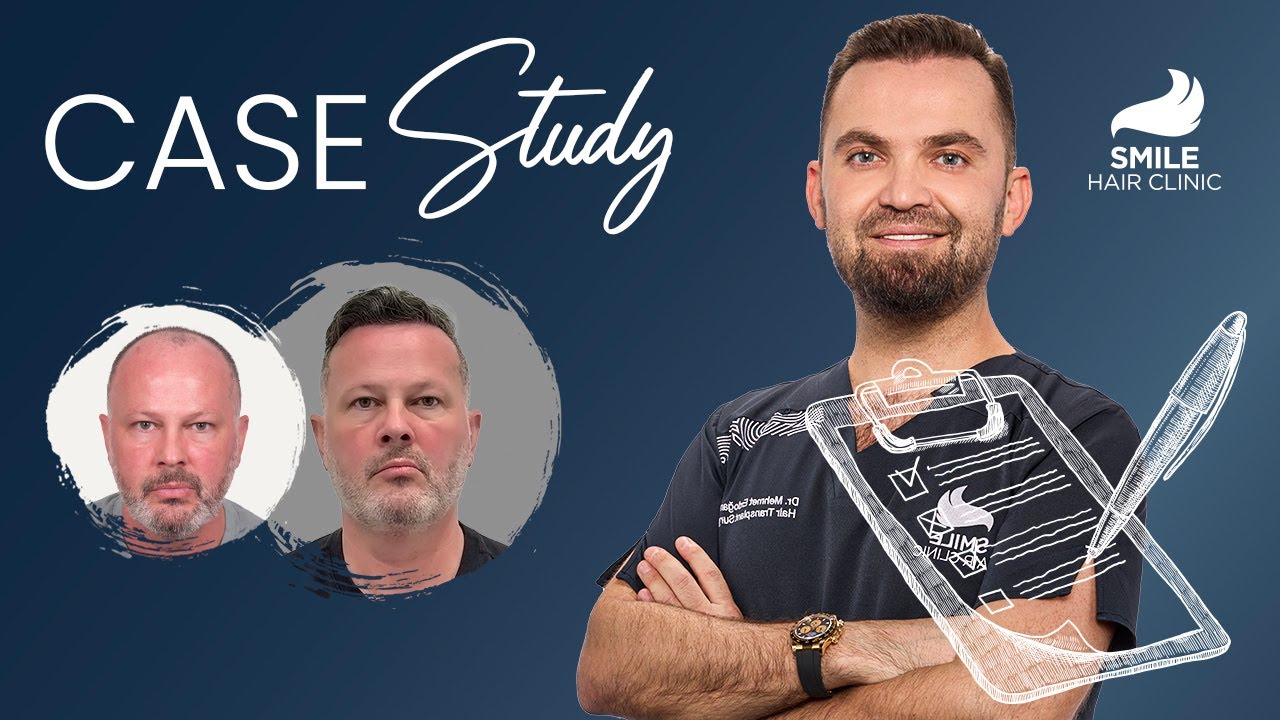 Case Study: 5700 Grafts - Dr. Erdogan's Mastery | 12 Month Transformation! - Hair Transplant