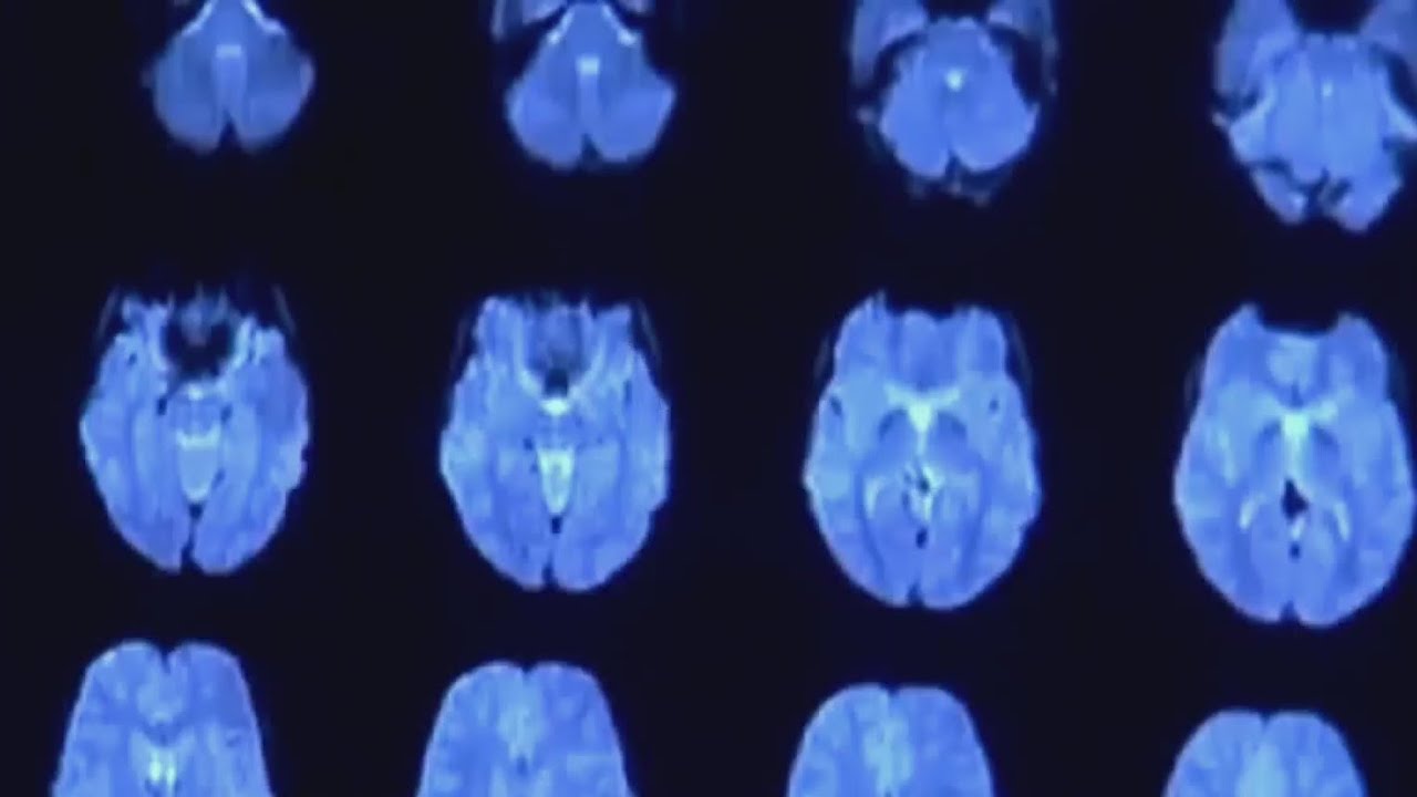 Over 100 people have registered in last 2 months for Pitt's National Sports Brain Bank