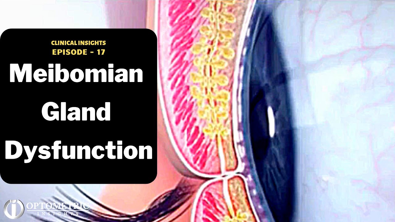 How to Treat MGD - Episode 17