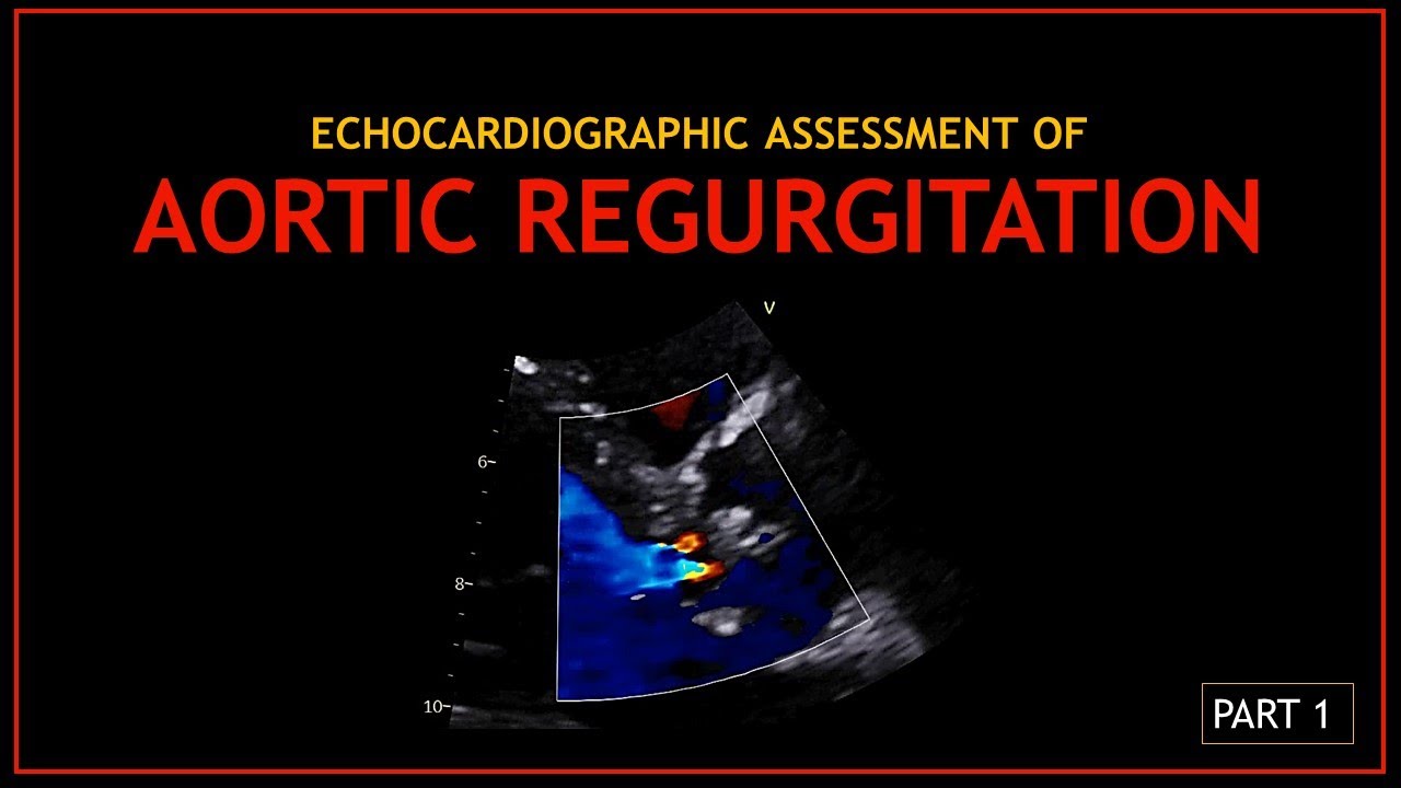 Echocardiographic Assessment of: AORTIC REGURGITATION (Part 1)