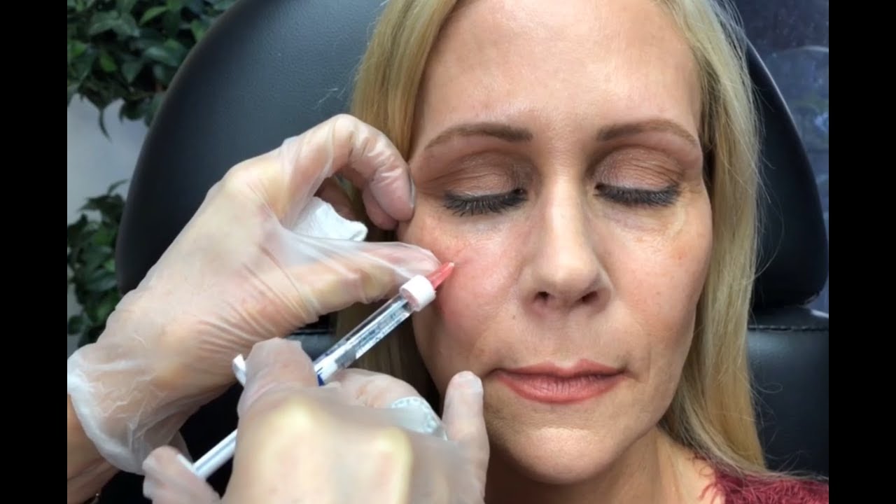 Dermal Filler Under Eyes /Tear Trough ~Restylane and Radiesse