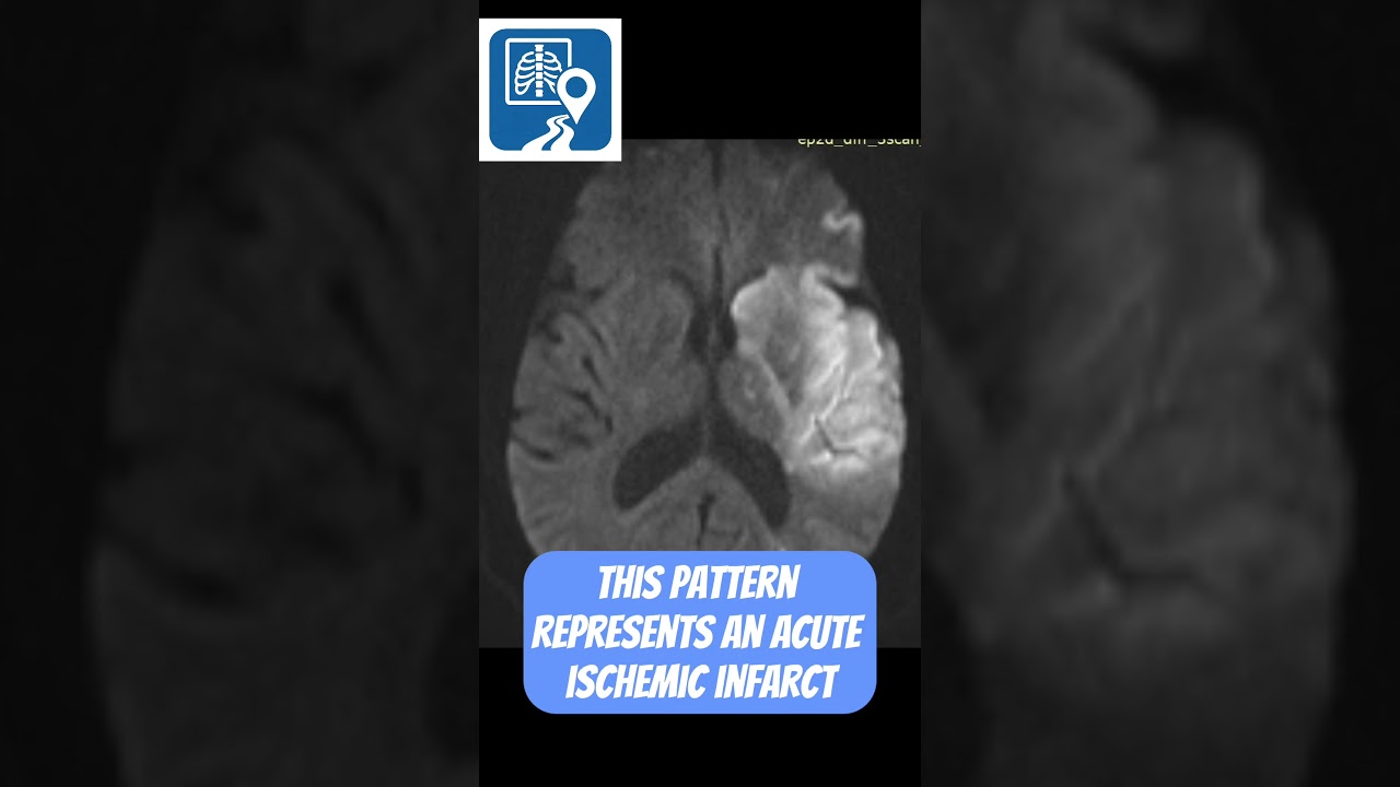 Something’s Not Right Here… MRI Clue Explained 