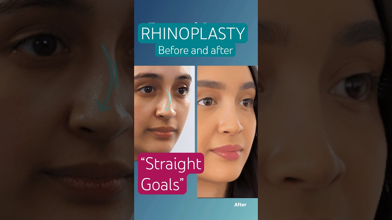 Septo-Rhinoplasty London | 23-Year-Old Nose Realignment by Mr. Taimur Shoaib #berkeleysquaremedical