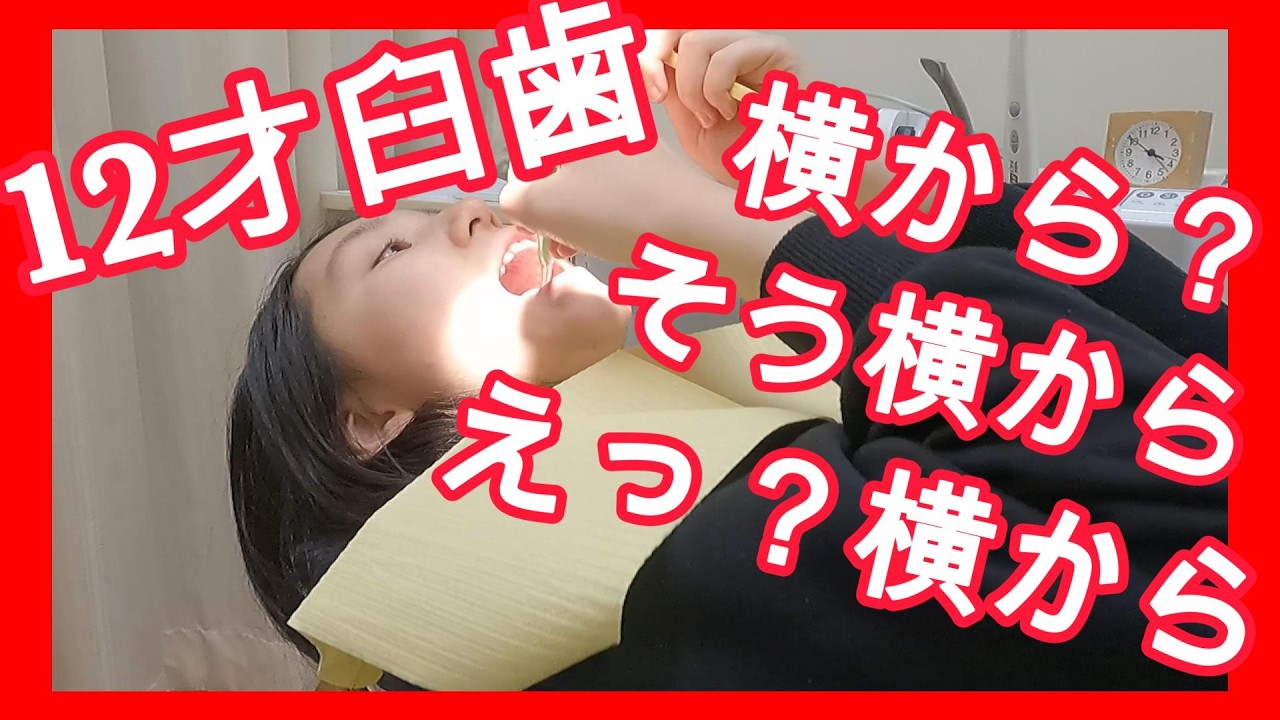 小学校高学年女子✴︎12才臼歯はえた？！｜予防歯科　原歯科医院【調布市・八雲台・布田駅】