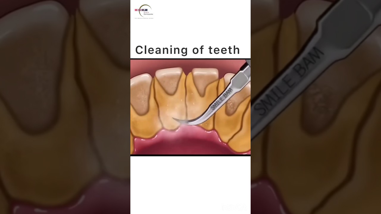 How is cleaning of teeth done at clinic? #scaling #teeth #delhidentist