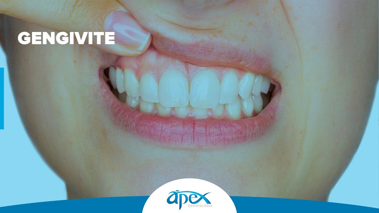 O que é GENGIVITE? O que CAUSA? | Dra. Lícia N. P. Gonzales CRO 61423 - Ápex Odontologia