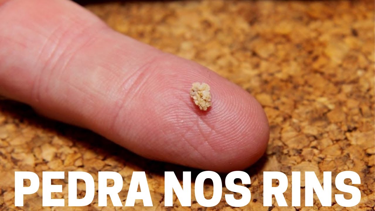 PEDRA NOS RINS: SINTOMAS E COMO ELIMIMINAR | Dr. Michel Palheta