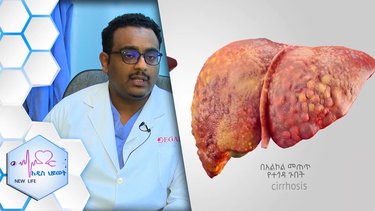 የጉበት ቫይረስ (Hepatitis) መንስኤዎችና ክትባቱ  ፤ የእሳት ቃጠሎ ክፍል 2
