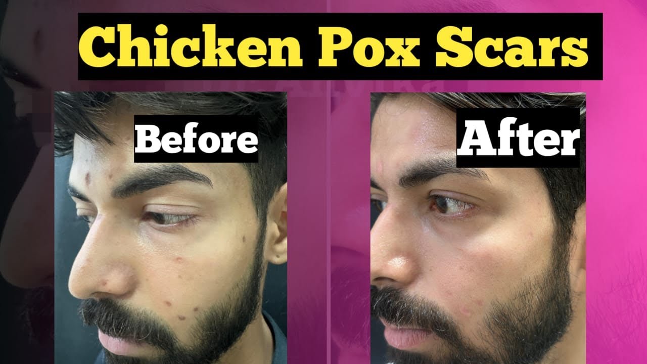 Chicken pox scar treatment with laser / 9999 747 717