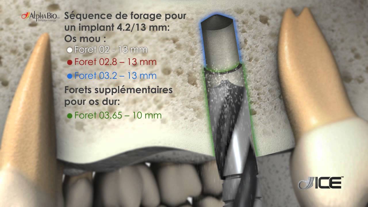 L&rsquo;implant dentaire ICE |  ALPHA-BIO TEC.