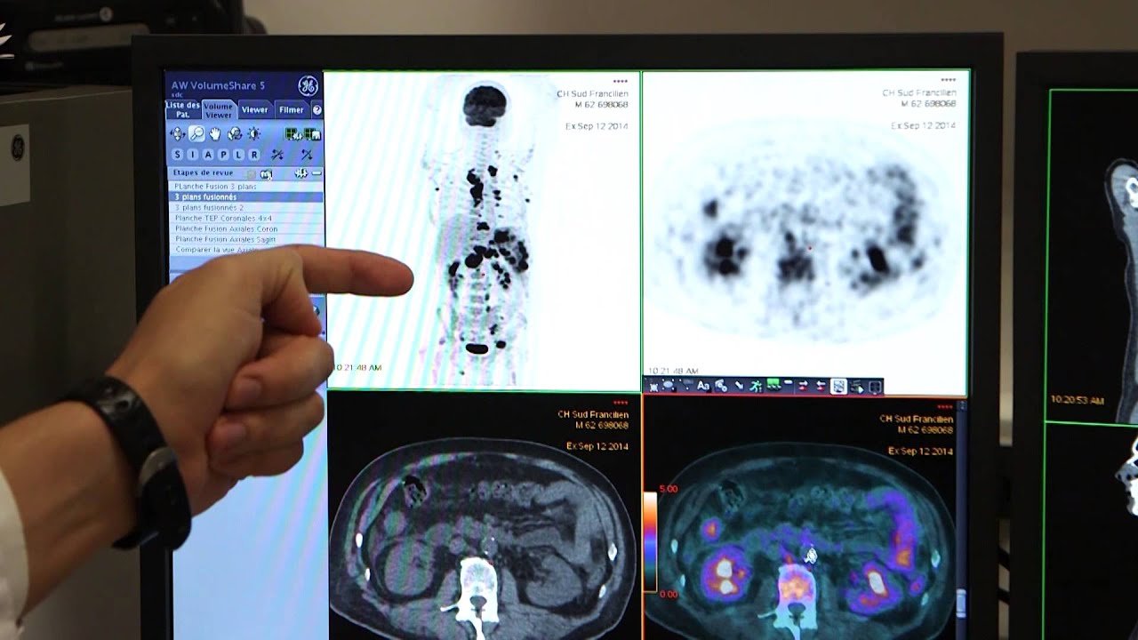 Le TEP-scan, pour un diagnostic précis
