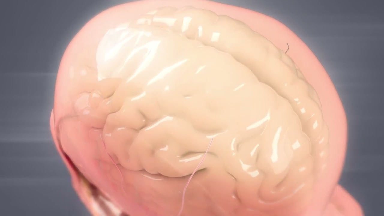 الدكتور خطاب عمر يتحدث عن سحب السائل الشوكي من الظهر