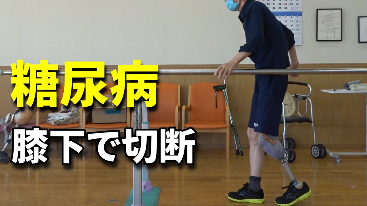 【下腿切断】糖尿病で膝から下を切断した男性【義足で歩く⑤】