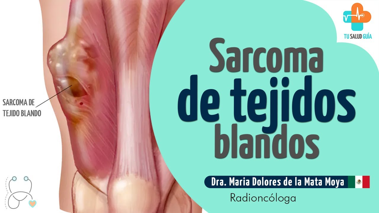 Sarcoma de tejidos blandos | Tu Salud Guía