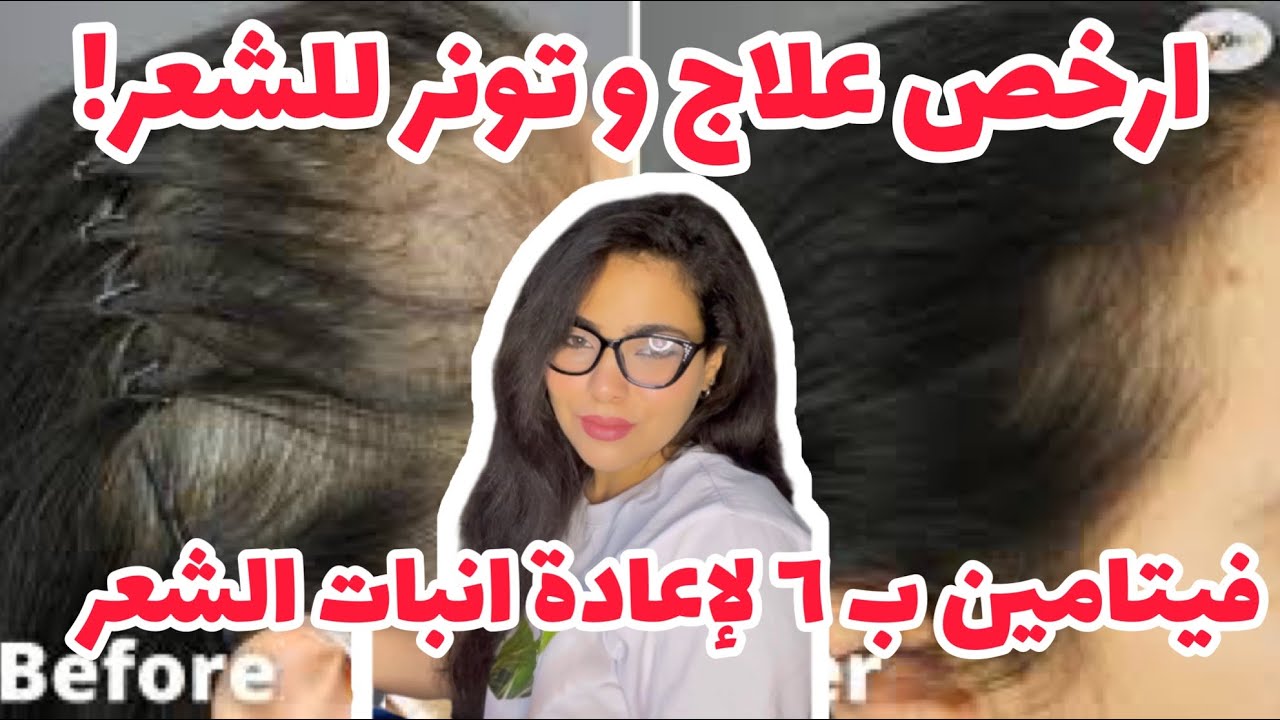 حقن فيتامين ب٦ لمقاومة الصلع و اعادة انبات الشعر و ازاي نعمل منها ارخص تونر للشعر |فرح محسن Drjoy