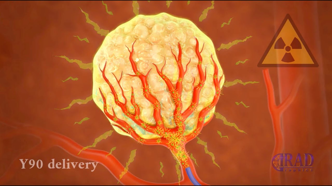 Liver Tumor Radioembolization