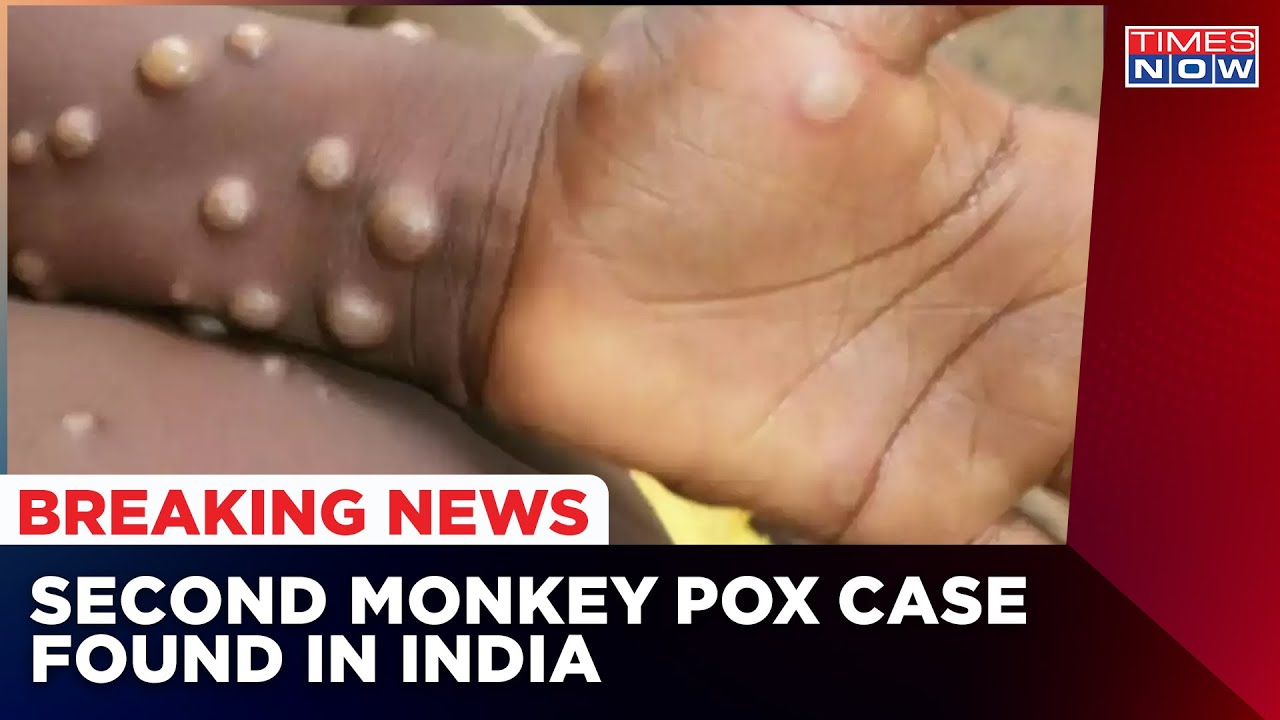 Another Monkey Pox Case Reported In Kerala; Government Takes Necessary Actions | Breaking News