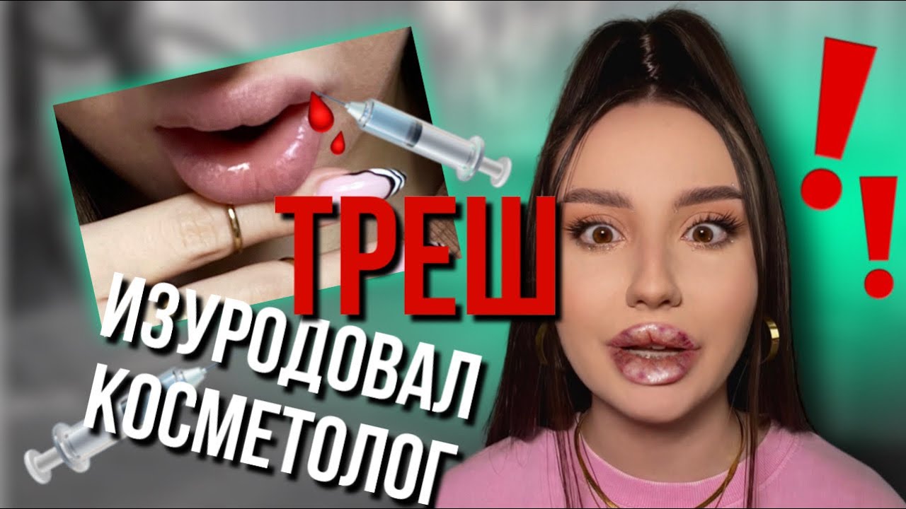КОСМЕТОЛОГ ИЗУРОДОВАЛ ГУБЫ 💋МОЯ ИСТОРИЯ НЕУДАЧНОГО УВЕЛИЧЕНИЯ ГУБ ЧАСТЬ 1