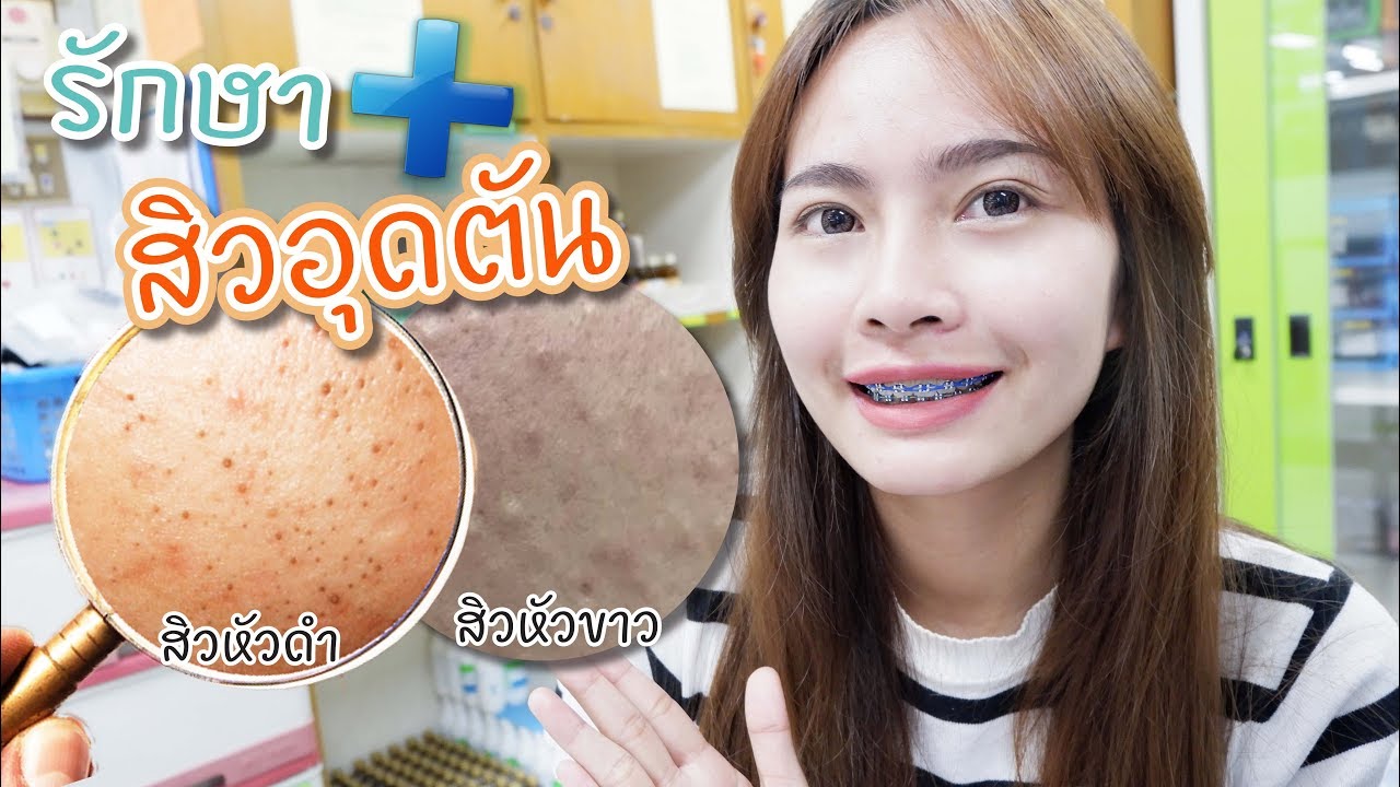 #39 รักษาสิวอุดตัน (สิวหัวดำ & สิวหัวขาว) ให้ได้ผล!!! 🌏 เภสัชท่องโลก
