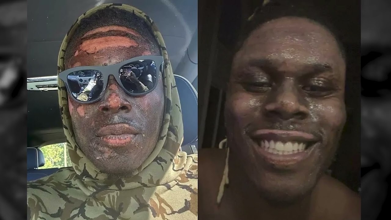 David Njoku shares his burn story for the first time | My Cause My Cleats