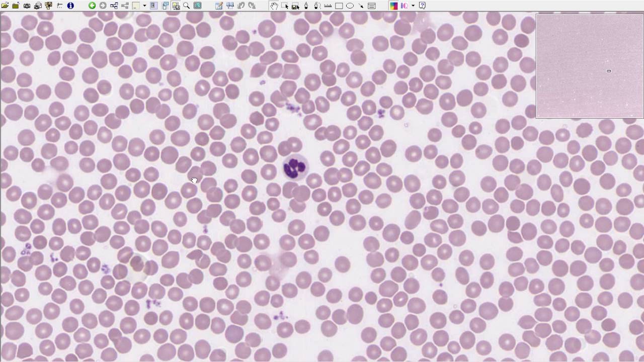 Hematoloji - Giriş, Periferik Yayma ve Kemik İliği