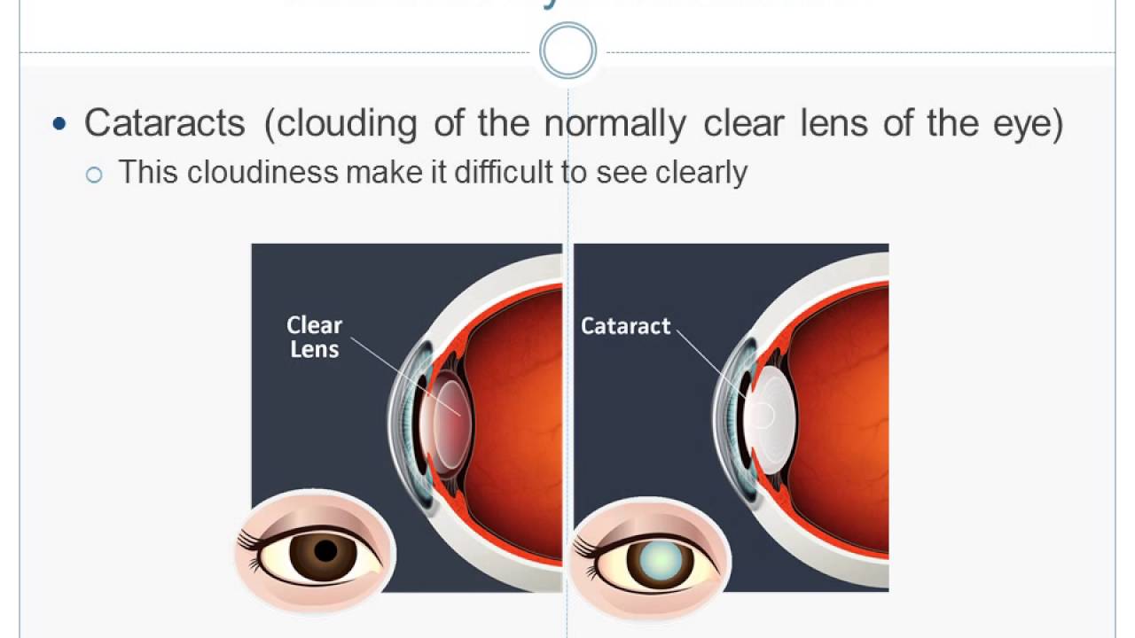 KAMRA Inlay Chicago Webinar | Foulkes Vision