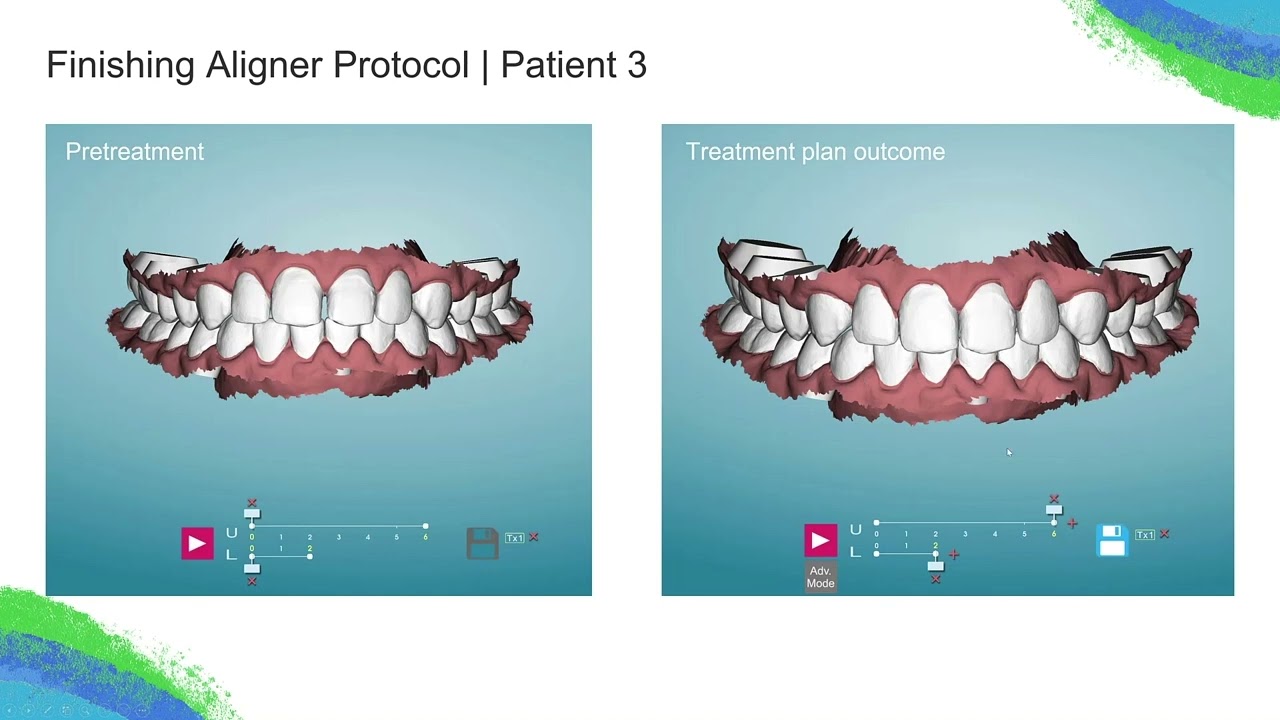 Webinar Clips: Dr. Rooz Finishing Aligner Protocol