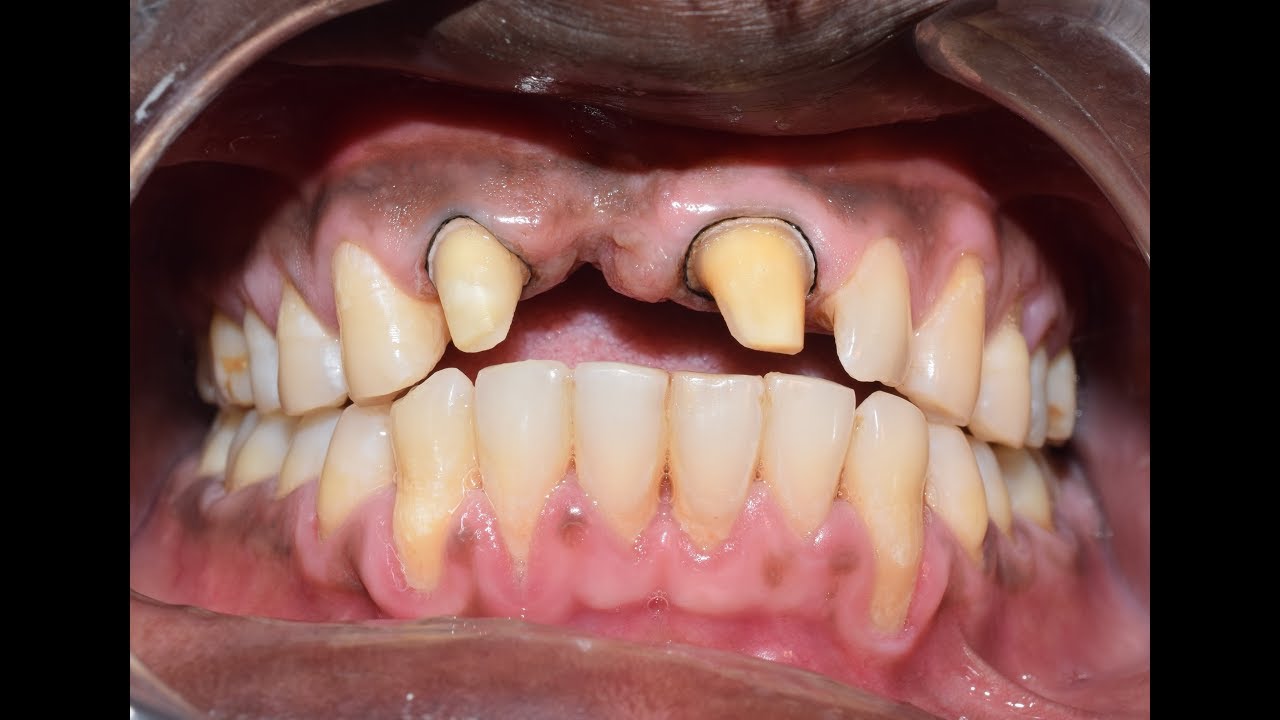 Ceramic Crown and Bridge - Crown Preparation | Impression Techniques | Temporary crown.