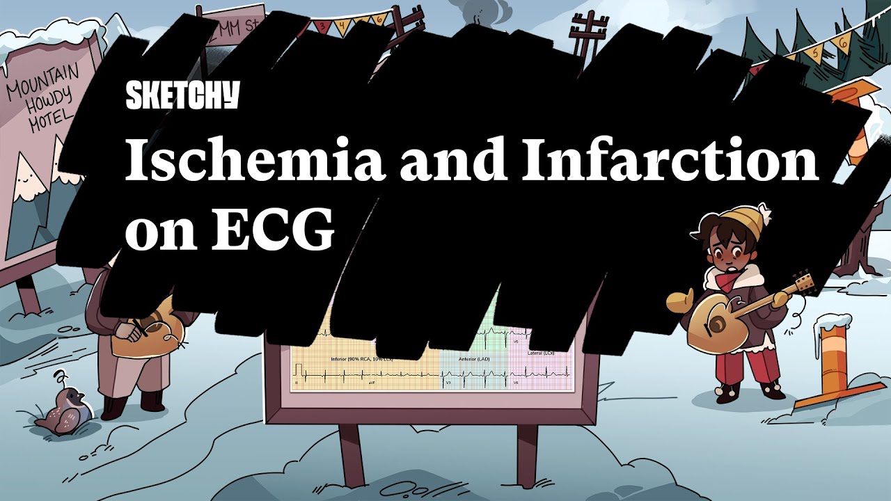 Ischemia & Infarction on ECG (Part 1) | Sketchy Medical | USMLE Step 2 CK