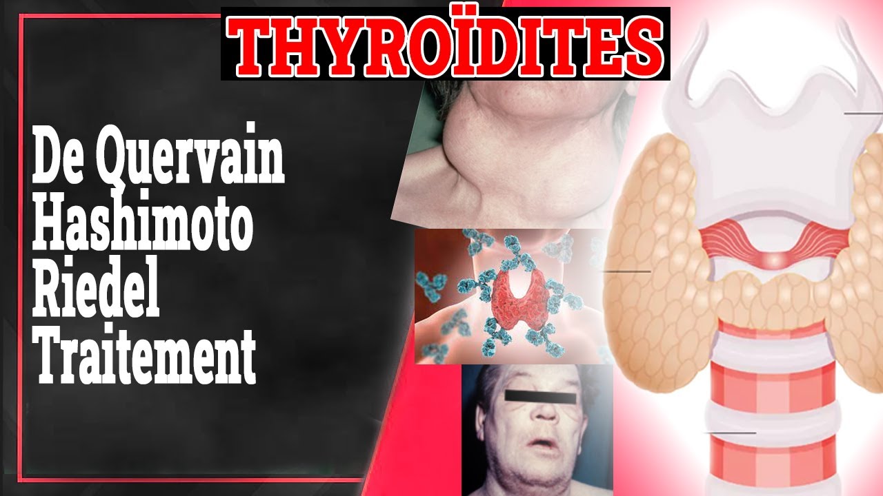 Les THYROÏDITES: De Quervain, Hashimoto... | Endocrinologie Medicale