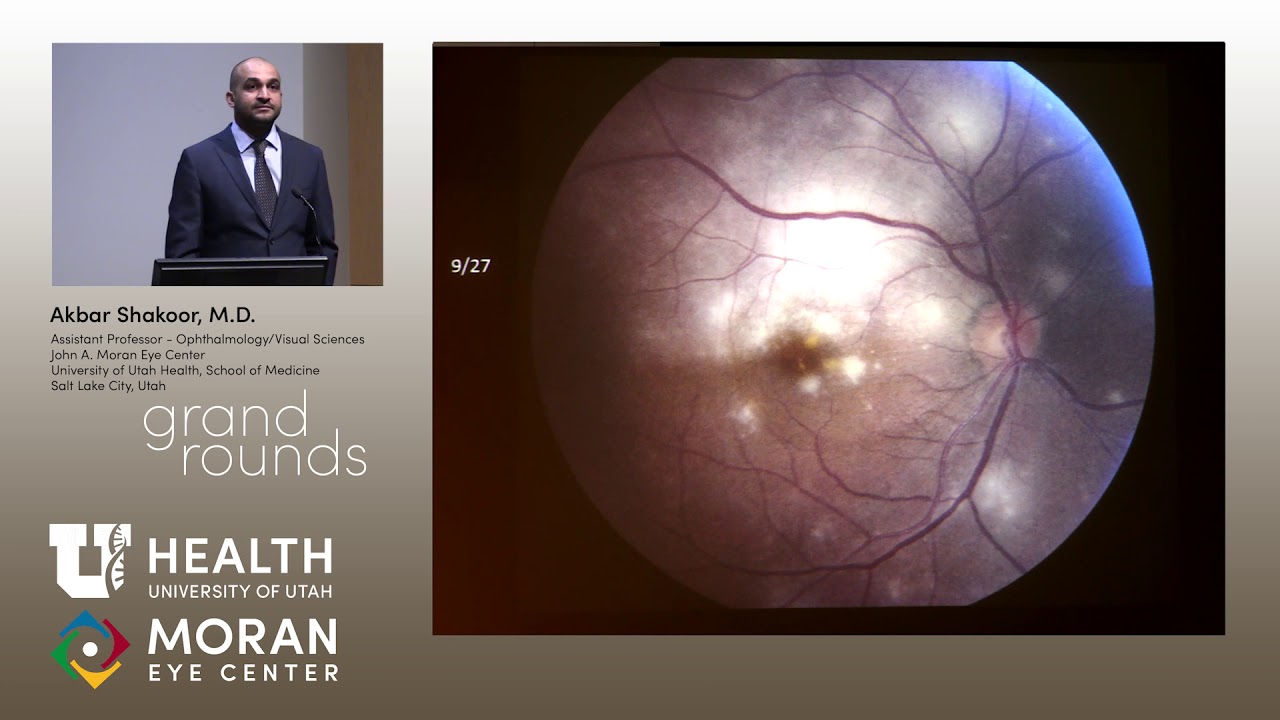 Uveitis Presentations