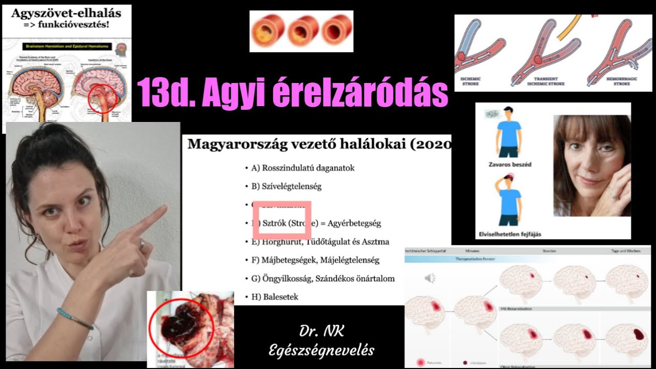 13. M.o. vezető halálokai - 13d. Stroke/ Szélütés/ Agyi érelzáródás