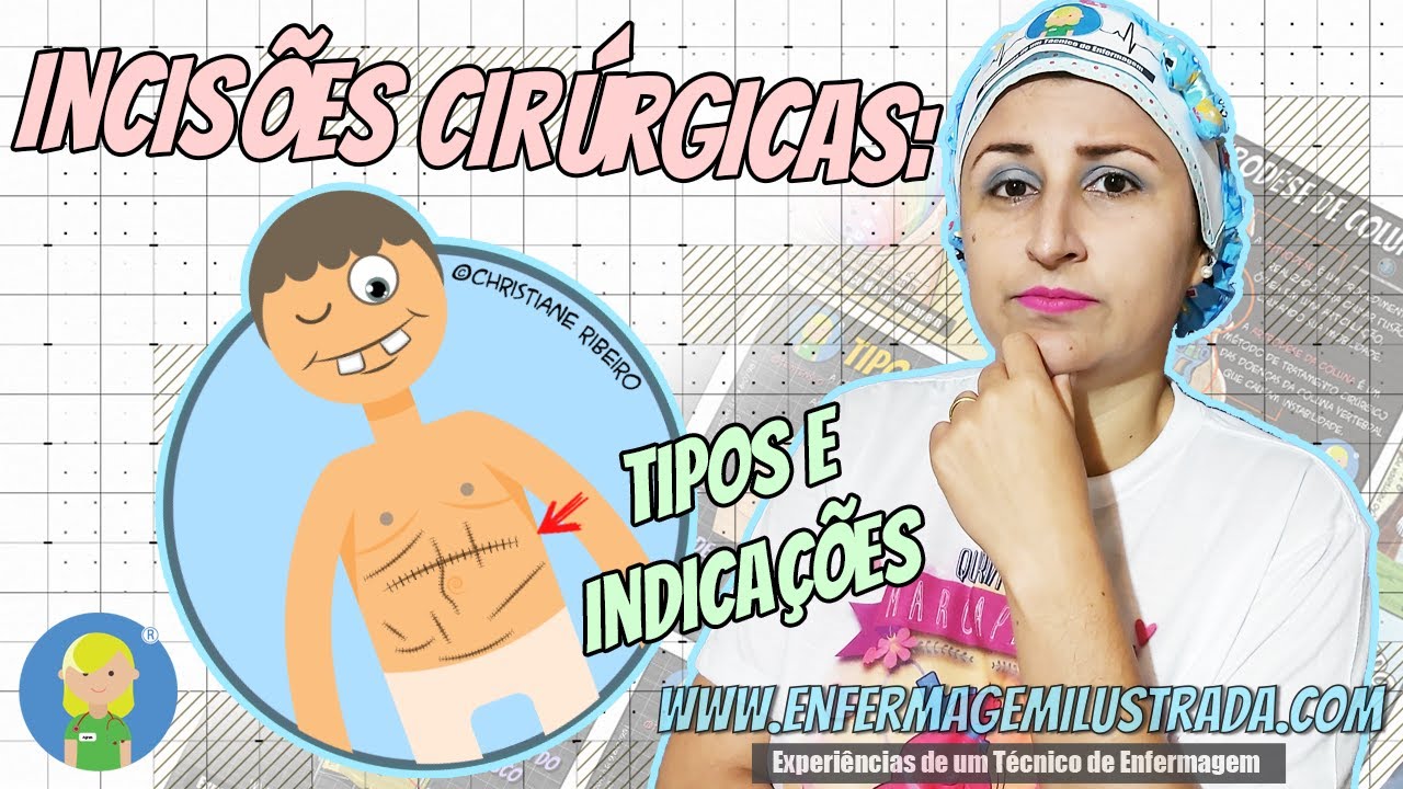 Tipos de INCISÕES Cirúrgicas ABDOMINAIS e suas INDICAÇÕES!