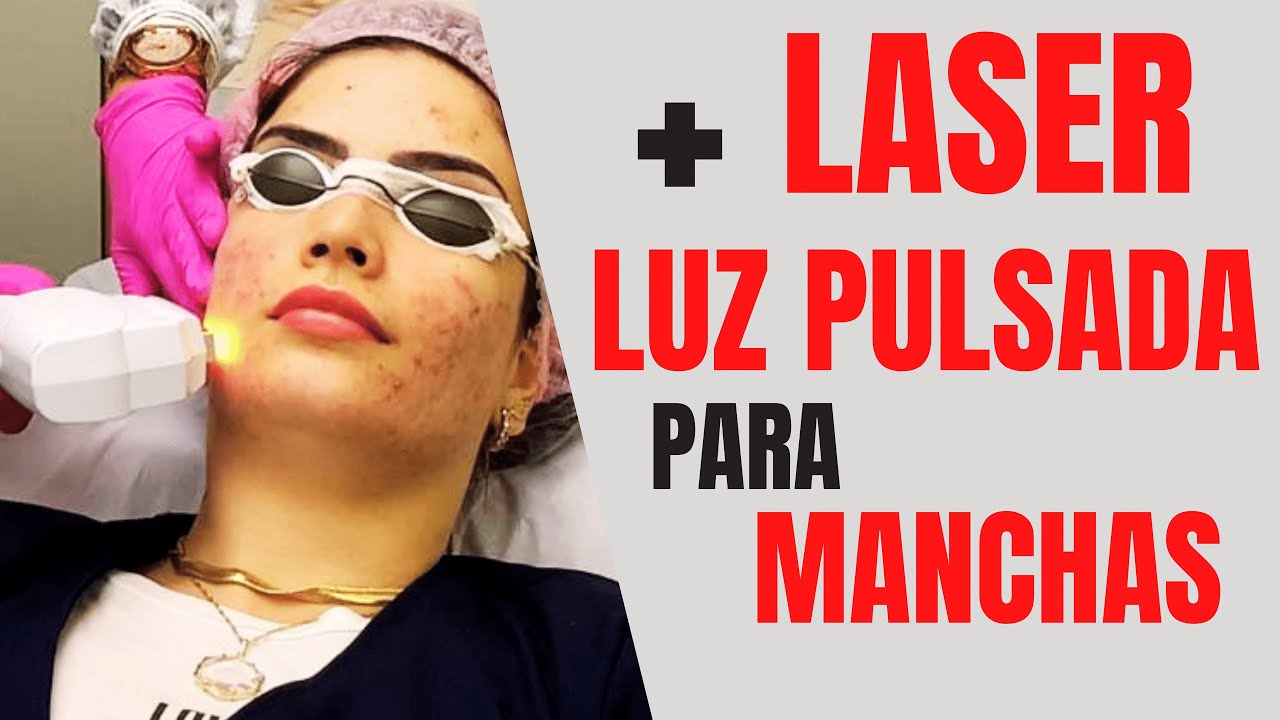 NOVIDADE!! PROCEDIMENTO para MANCHAS e CICATRIZES de ACNE [ESPINHAS] com LASER e LUZ PULSADA