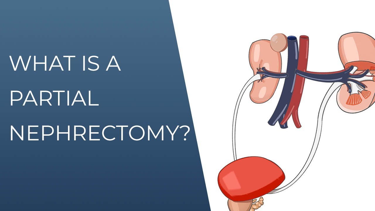 What is a partial nephrectomy?