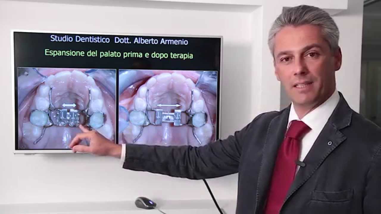 Palato stretto